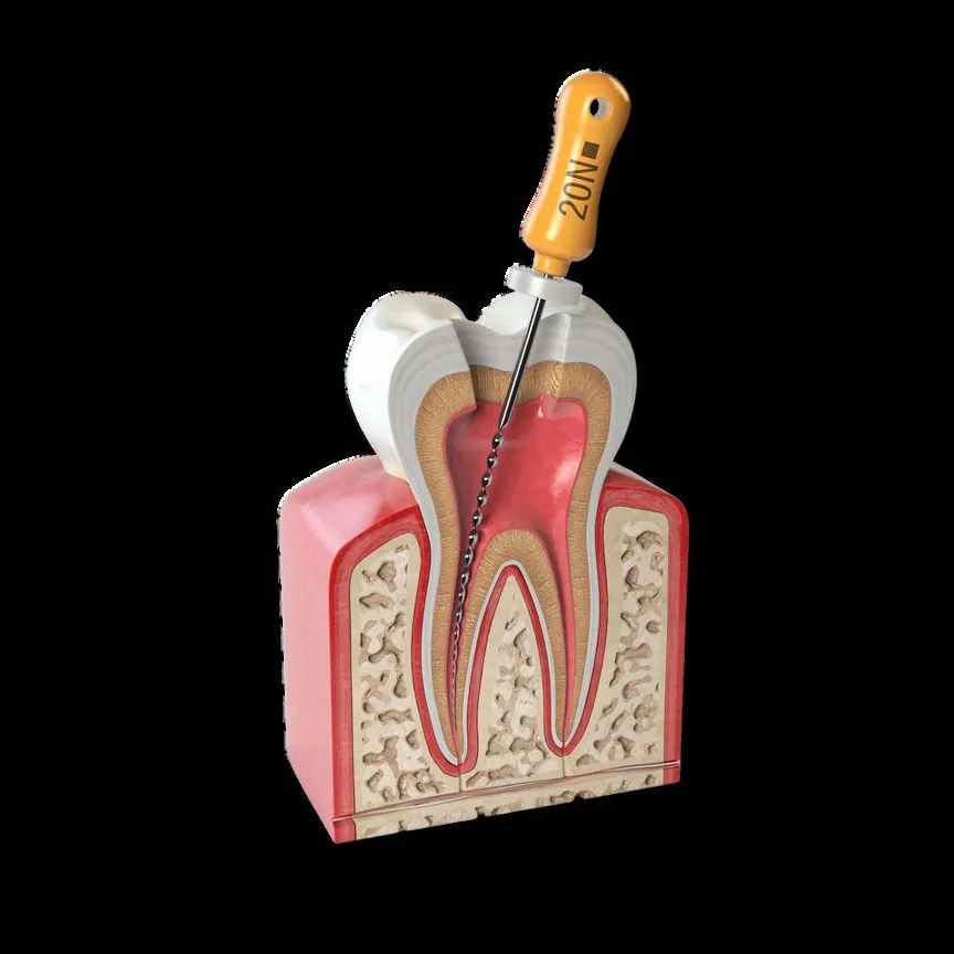 Endodoncia: limpieza del conducto de la raíz del diente