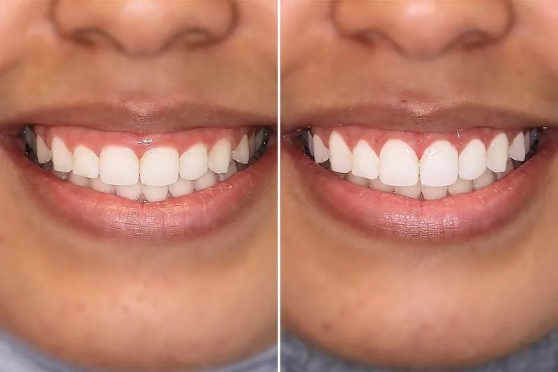 Antes y después de una gingivoplastia para corregir la sonrisa gingival