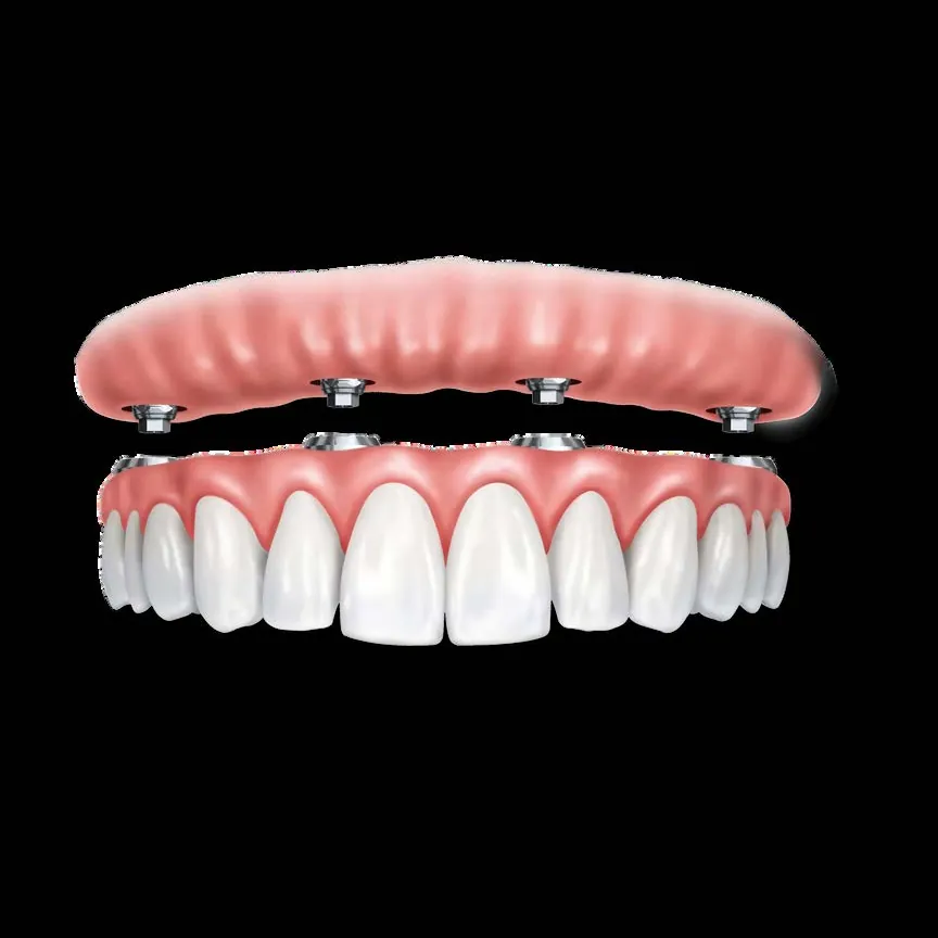 Prótesis fija completa atornillada sobre implantes